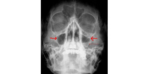 radiografia de sinus