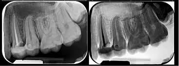 radiografie dentara retro-alveolara