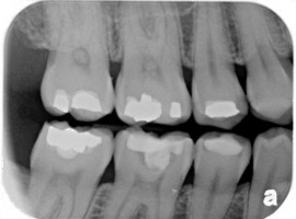 radiografie dentara tip "bitewing"