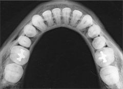 radiografie ocluzala